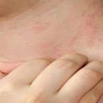 تجربتي في علاج حساسية الجلد