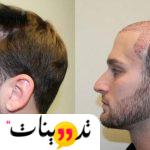 تجربتي مع زراعة الشعر في الرياض