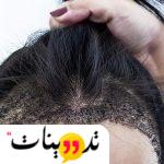 تجربتي مع زراعة الشعر في جده