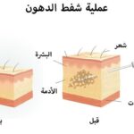 تجربتي مع عملية شفط الدهون مخاطرها وتكلفتها