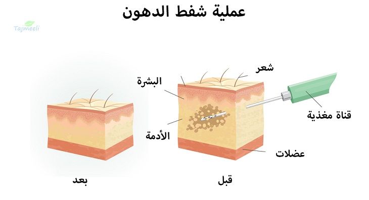 تجربتي مع عملية شفط الدهون مخاطرها وتكلفتها