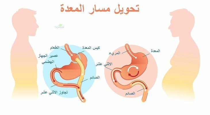 كم ينزل المتكمم في الشهر الاول ومخاطر التكميم